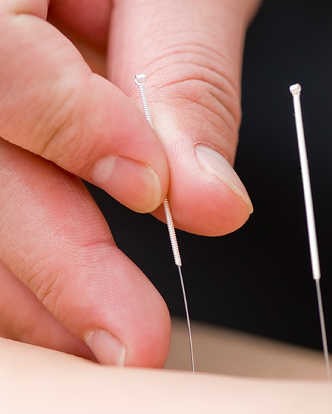 Acupuncture | Elevate Chiropractic | Chiropractic & Wellness Clinic | SW Calgary